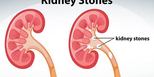 Dissolve calcium oxalate type kidney stones